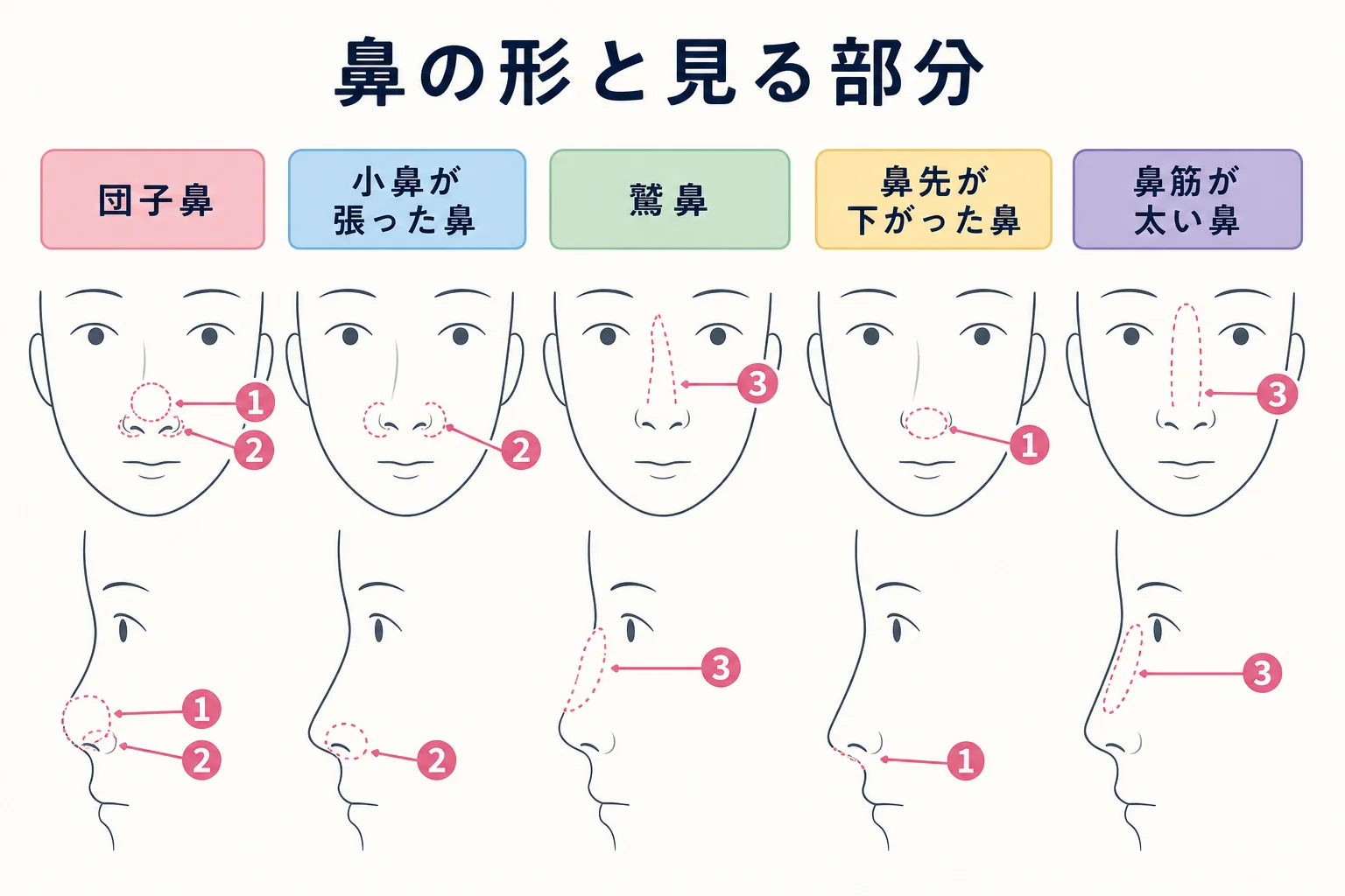 団子鼻・小鼻が張った鼻・鷲鼻・鼻先が下がった鼻・鼻筋が太い鼻を横顔と正面顔の線画で並べた図解