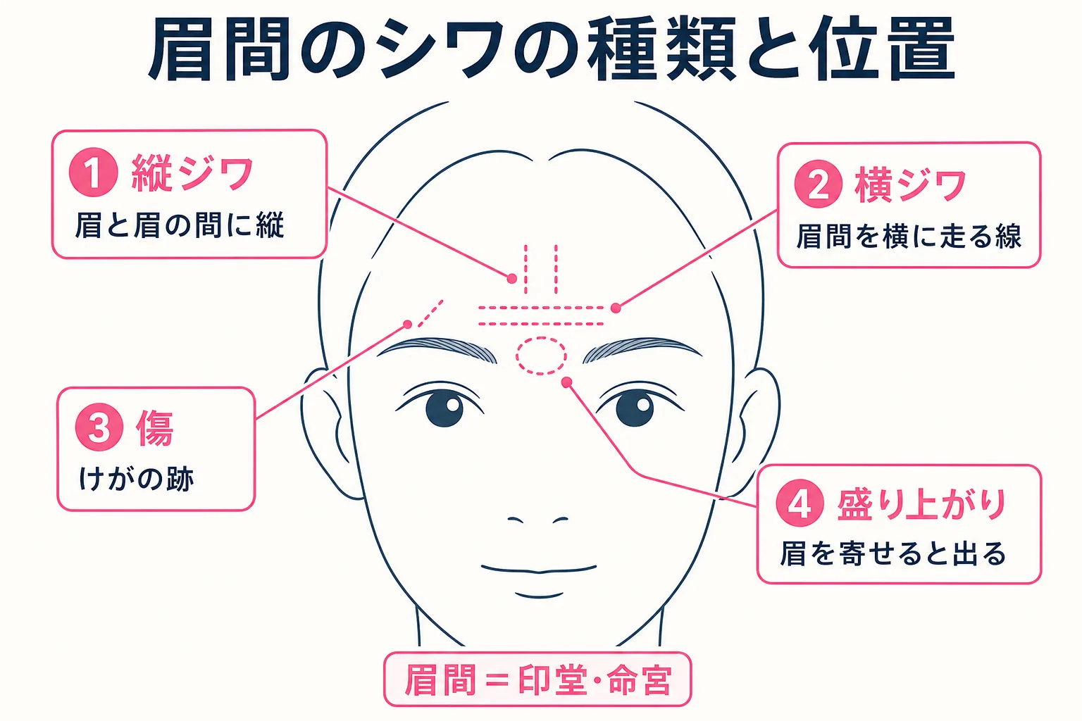 眉間の縦ジワ・横ジワ・傷・盛り上がりの位置を正面顔の線画で示した図解