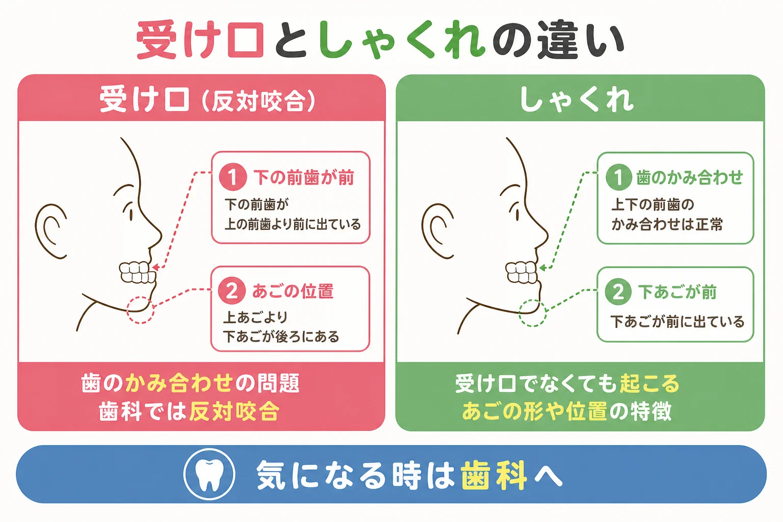 受け口としゃくれの違いを横顔の線画で示した図解